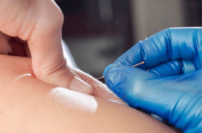 Dry needling in West End Physiotherapy