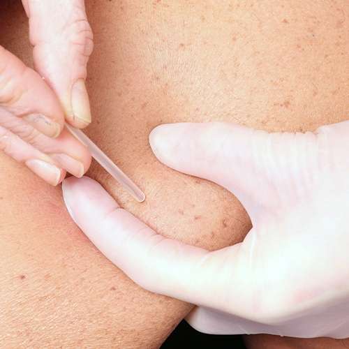 Dry Needling in West End Physiotherapy