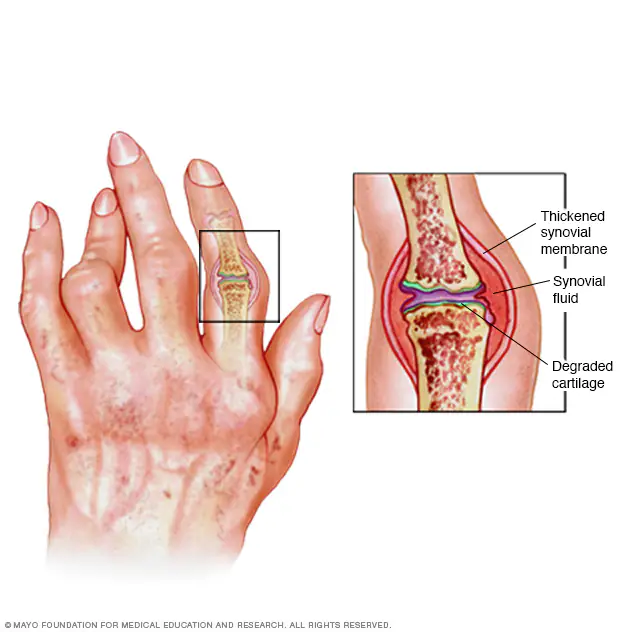 An image of a hand with a zoomed in cut away to the inner joint capsule of a finger joint with Rheumatoid Arthritis. The thickened membrane around the joint & degraded cartilage are the highlights