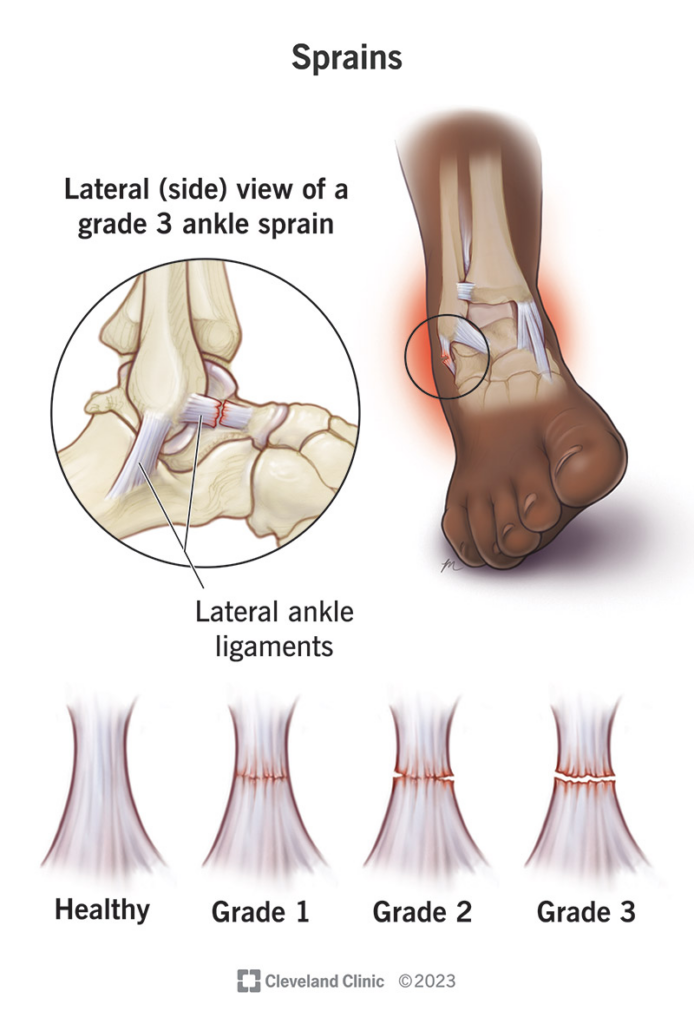 prevent falls through Physiotherapy to avoid sprains
