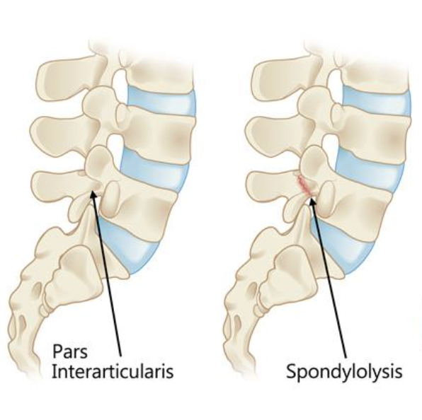 Low Back Pain / Pars stress