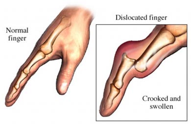Finger Sprains/Dislocations