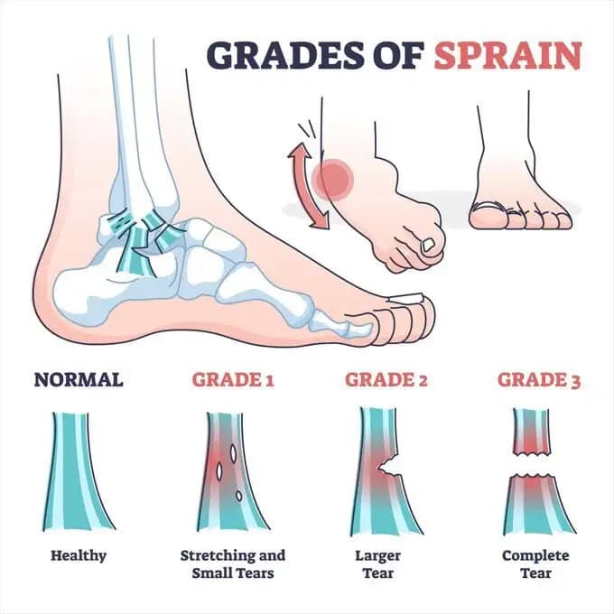 Lateral Ankle Sprain