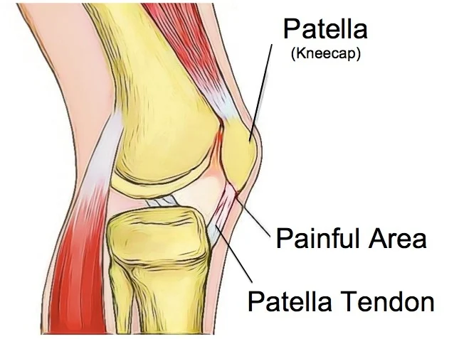 Patellar Tendinopathy