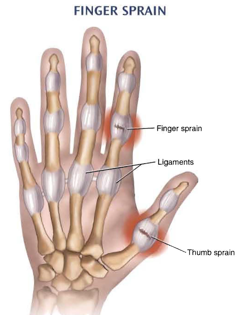 Finger Sprains/Dislocations